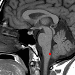 Red oval indicates the approximate location of the area postrema, which is commonly involved in neuromyelitis optica.