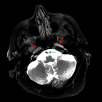 Abnormal signal hyperintensity in the bilateral internal carotid arteries (red arrows) on this spin echo T2 sequence compared to normal signal hypointensity in the basilar artery (green arrow).