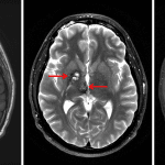 Cerebral cavenous malformations (cavernomas) centered in the right globus pallidus and right midbrain (red arrows) with associated T1 and T2 internal hyperintensity (left and middle images) and blooming on susceptibility-weighted imaging (right image).