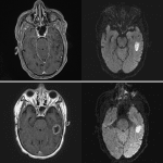 1 week followup imaging in this patient (bottom two images) shows progression from late cerebritis to abscess with development of peripheral enhancement and persistent central restricted diffusion.