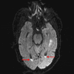 Restricted diffusion in the dependent aspects of the occipital horns of both lateral ventricles (red arrows), concerning for ventriculitis.