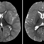 Contrast the T2 sequence in this patient with severe cerebral edema on the left to a normal comparison 9-month old on the right.