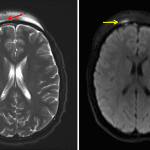 Thin subperiosteal collection along the outer table of the frontal bone on the right (red arrows) with associated restricted diffusion (yellow arrow) consistent with subperiosteal abscess.