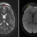 Thin right frontal subdural collection (red arrows) with associated restricted diffusion (yellow arrow) consistent with a subdural empyema.