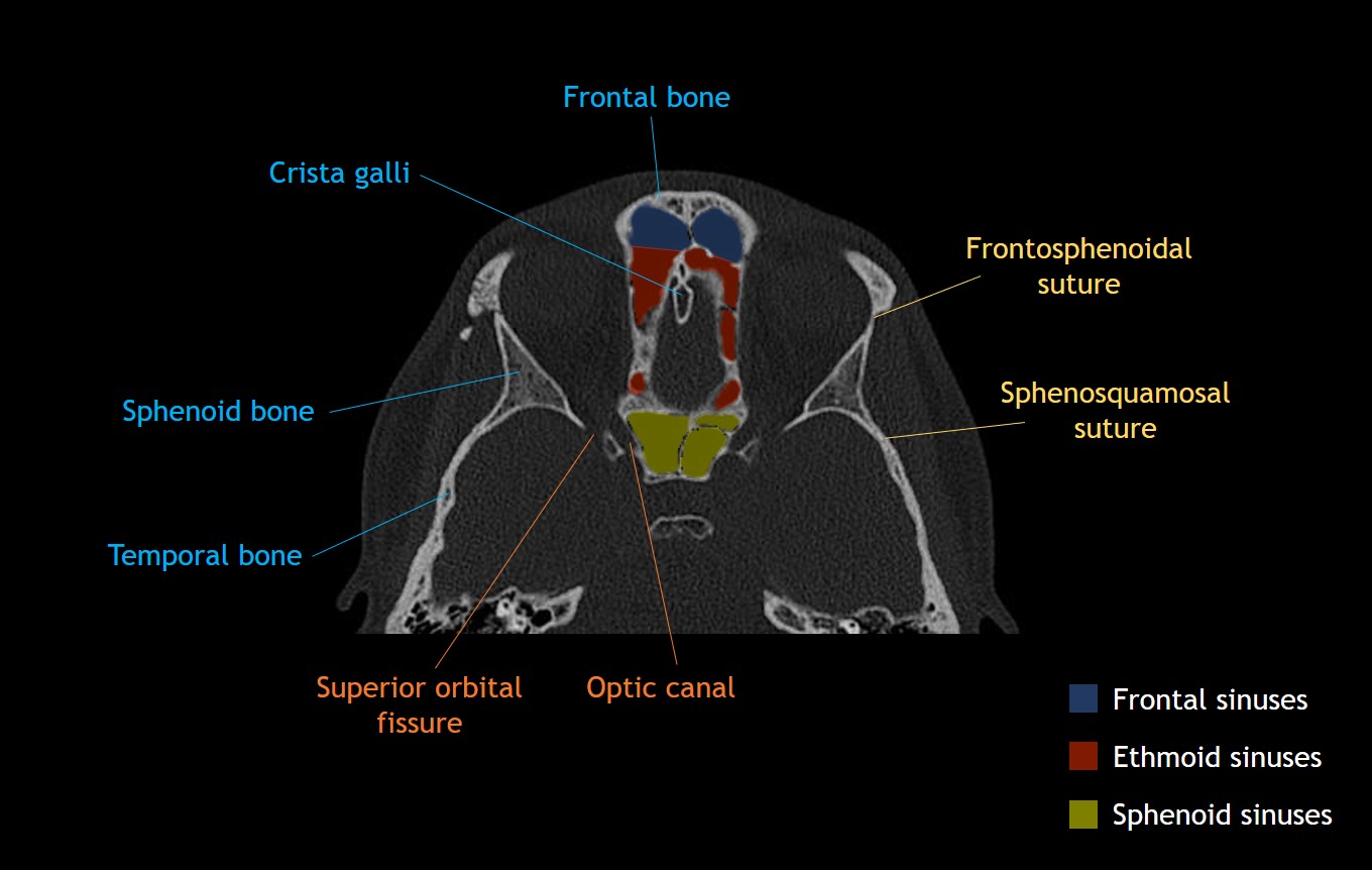 Face Bone Anatomy Ct