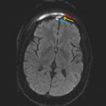 Contiguous abscess development involving the subgaleal right frontal scalp (red arrow), right frontal sinus (yellow arrow), and right epidural space (blue arrow).