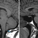 Classic findings of intracranial hypotension including upward convex appearance of the pituitary gland (red arrow), low-lying optic chiasm (yellow arrow), and inferior descent of the cerebellar tonsils (blue arrow). Normal comparison on the right.