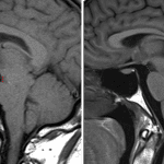 Decreased mamillopontine distance in this patient with intracranial hypotension on the left; normal control on the right.