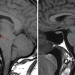 Decreased pontomesencephalic angle in this patient with intracranial hypotension on the left; normal control on the right.