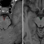 Decreased interpeduncular angle in this patient with intracranial hypotension on the left; normal control on the right.
