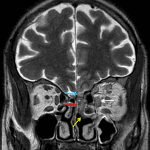Invasive fungal sinusitis involving left ethmoid air cells and extending along the left middle turbinate (yellow arrow), into the left olfactory recess (red arrow), along the floor of the left anterior cranial fossa (blue arrow), and into the left orbit with thickening of the left medial rectus muscle (white arrow).