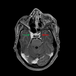 Abnormal nonopacification of the left cavernous sinus (red arrow) compared to the normal right side (green arrow) indicative of cavernous sinus thrombosis.