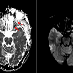 Restricted diffusion involving the orbital and canalicular segments of the left optic nerve (red arrows) concerning for infectious involvement and/or ischemia.