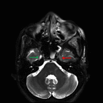 Abnormal T2 signal hypointensity in the left Meckel's cave (red arrow) compared to the normal appearance on the right (green arrow) concerning for infectious involvement.