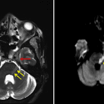 Abnormal T2 signal hypointensity in the left Meckel's cave (red arrow) compared to the normal appearance on the right (green arrow) with restricted diffusion extending from the left Meckel's cave along the cisternal segment of the left trigeminal nerve into the dorsolateral pons (yellow arrows) concerning for perineural spread of infection to the brainstem.
