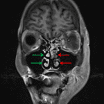 Hypoenhancement of the left middle and inferior nasal turbinates (red arrows) compared to the normal appearance on the right (green arrows) concerning for necrosis.