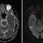 Restricted diffusion in the right optic nerve (red arrows) concerning for ischemic optic neuropathy.
