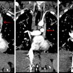 Subsequent CT in this patient shows a persistent left SVC coursing along the left aspect of the mediastinum and draining into the coronary sinus (red arrows). The patient had no left brachiocephalic vein.
