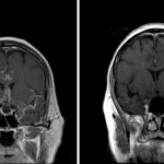 Contrast the leptomeningeal enhancement pattern in this case (image on the left) to pachymeningeal disease in a different patient (image on the right), which does not extend into fissures or sulci.