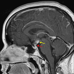 Thickening and abnormal enhancement of the pituitary stalk (red arrow) and hypothalamus (yellow arrow) in this patient with lymphocytic infundibulohypophysitis.