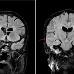 Multiple areas of sulcal FLAIR signal hyperintensity along the right temporal lobe (red arrows). FLAIR pseudolesion in the frontal horn of the right lateral ventricle related to CSF pulsation (yellow arrow).