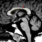Small lesion in this patient involving the isthmus of the corpus callosum (red arrow) along the callososeptal interface (yellow dotted line), which is typical for multiple sclerosis.