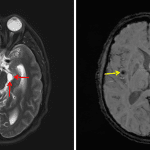 Neurocysticercosis with cysts of varying stages including a cyst in the left perimesencephalic cistern in the vesicular stage (red arrows) and a cyst in the right subinsular region in the calcified nodular stage (yellow arrow).