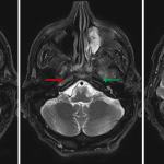Abnormal signal in the right internal carotid artery (red arrows) on this T2-weighted sequence compared to the normal flow-related signal loss in the left internal carotid artery (green arrows).
