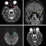 Optic neuritis: Expansion of the intraorbital left optic nerve with T2 hyperintensity (red arrow), diffuse enhancement (yellow arrow), and restricted diffusion (blue arrows).