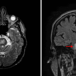 T2/FLAIR hyperintensity in the central pons (red arrows) in this patient with osmotic demyelination syndrome.