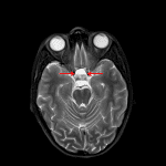 Fluid-fluid level in the enlarged pituitary (red arrows) on this T2-weighted sequence, which is a helpful supportive finding when making the diagnosis of pituitary apoplexy.