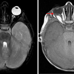 Mixed T2 (left) and T1 (right) signal material layering in the vitreous chamber of the right globe (red arrows) concerning for hemorrhage.