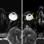 Left image: retinal detachment with the characteristic V-shaped appearance extending anteriorly from the optic disc to the 10:00 and 2:00 positions (red arrows). Right image: companion case of choroidal detachment with a more U-shaped configuration sparing the optic disc and extending beyond the 10:00 and 2:00 positions (yellow arrows).