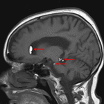 Globules of T1 signal hyperintensity layering antidependently in the ventricles and extraaxial CSF spaces (red arrow), which is the classic appearance for a ruptured dermoid cyst.