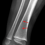 Nondisplaced oblique fracture of the distal tibial metadiaphysis (red arrows).
