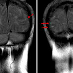 Examples of sulcal FLAIR signal hyperintensity from this case (red arrows).