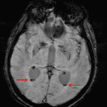 Trace blood layering in the occipital horns of both lateral ventricles (red arrows), best appreciated on this susceptibility-weighted sequence.