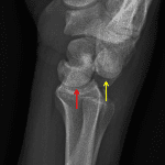Perilunate dislocation with dorsal dislocation of the capitate (yellow arrow) relative to the lunate (red arrow).