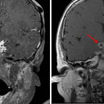 Followup imaging 2.5 years after the initial presentation (on right) shows decreased bulk of enhancing soft tissue with a residual peripherally enhancing tuberculoma (red arrows).