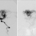 Sequential images from digital subtraction angiography in this patient showing an extensive network of arterial feeders from the posterior circulation (the left vertebral artery was injected) quickly filling a large dilated venous structure draining to the torcula.