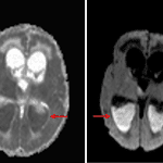 Large amount of material layering in both lateral ventricles with associated restricted diffusion (red arrows) comparing the ADC map on the left to the diffusion sequence on the right, indicative of pus in the ventricles in the setting of ventriculitis.