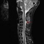 Severe thinning and possible disruption of the ligamentum flavum (red arrow).