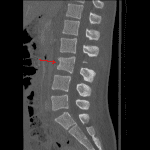 Contemporaneous CT from the same patient showing the three-column fracture (red arrow).