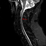 Large disc herniation at C3-C4 with an associated traumatic cord contusion (red arrow).