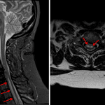 Ventral cord signal T2/STIR hyperintensity (red arrows) taking the characteristic owl's eye appearance of gray matter involvement in the axial T2-weighted image on the right. Yellow arrow indicates susceptibility artifact from the anterior spinal fusion hardware.