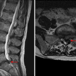Left paracentral disc extrusion (red arrows) resulting in mass effect on nerve roots of the cauda equina and specifically displacement and deformity of the descending left S1 nerve roots.