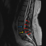 Large dorsal epidural hematoma resulting in uplifting of the posterior dura (red arrows) and contributing to severe spinal canal stenosis at L4-L5 (blue arrow) and L5-L6 (yellow arrow).