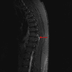Fluid signal one of the facet joints at T8-T9 (red arrow) concerning for facet capsular injury.