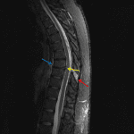Edema in the interspinous ligament (red arrow) and possible disruption of the anterior longitudinal ligament (blue arrow) and posterior longitudinal ligament (yellow arrow).