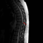 Focal disruption of the ligamentum flavum at the level of T8-T9 (red arrow).